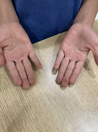 9歲小學(xué)生長期拍煙卡，手部粗糙長繭。受訪者供圖